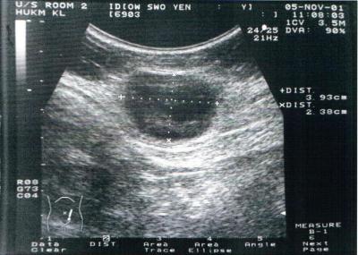 Figure 1:	Ultrasound showed a fairly well defined inhomogenous soft tissue mass, measuring about 4x4x2.6cm in the deep subcutaneous region in left iliac fossa